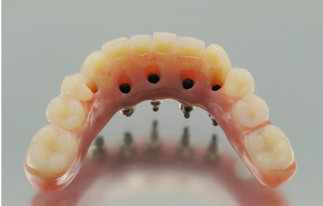 Permanent dentures