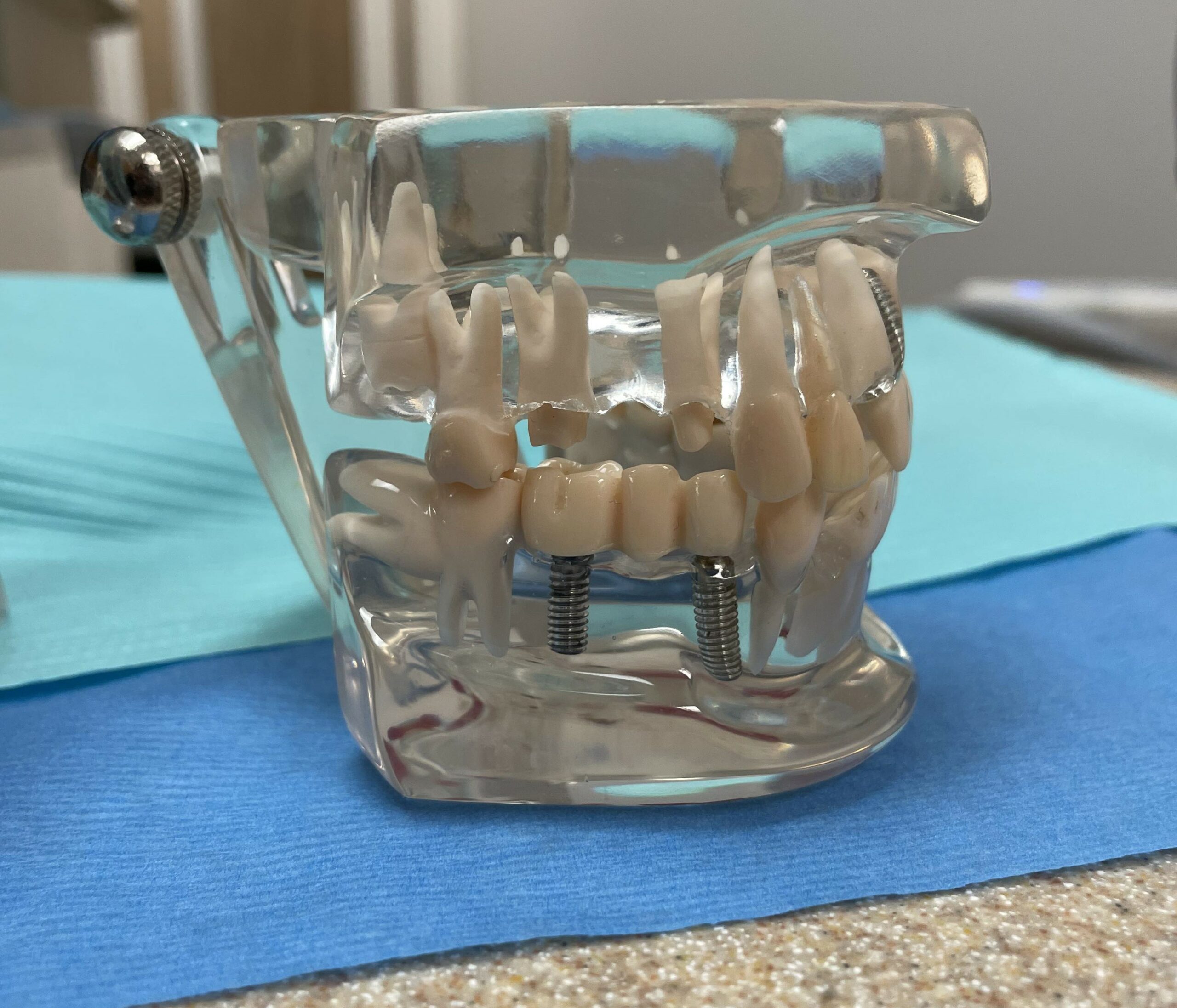 dental implant bridge