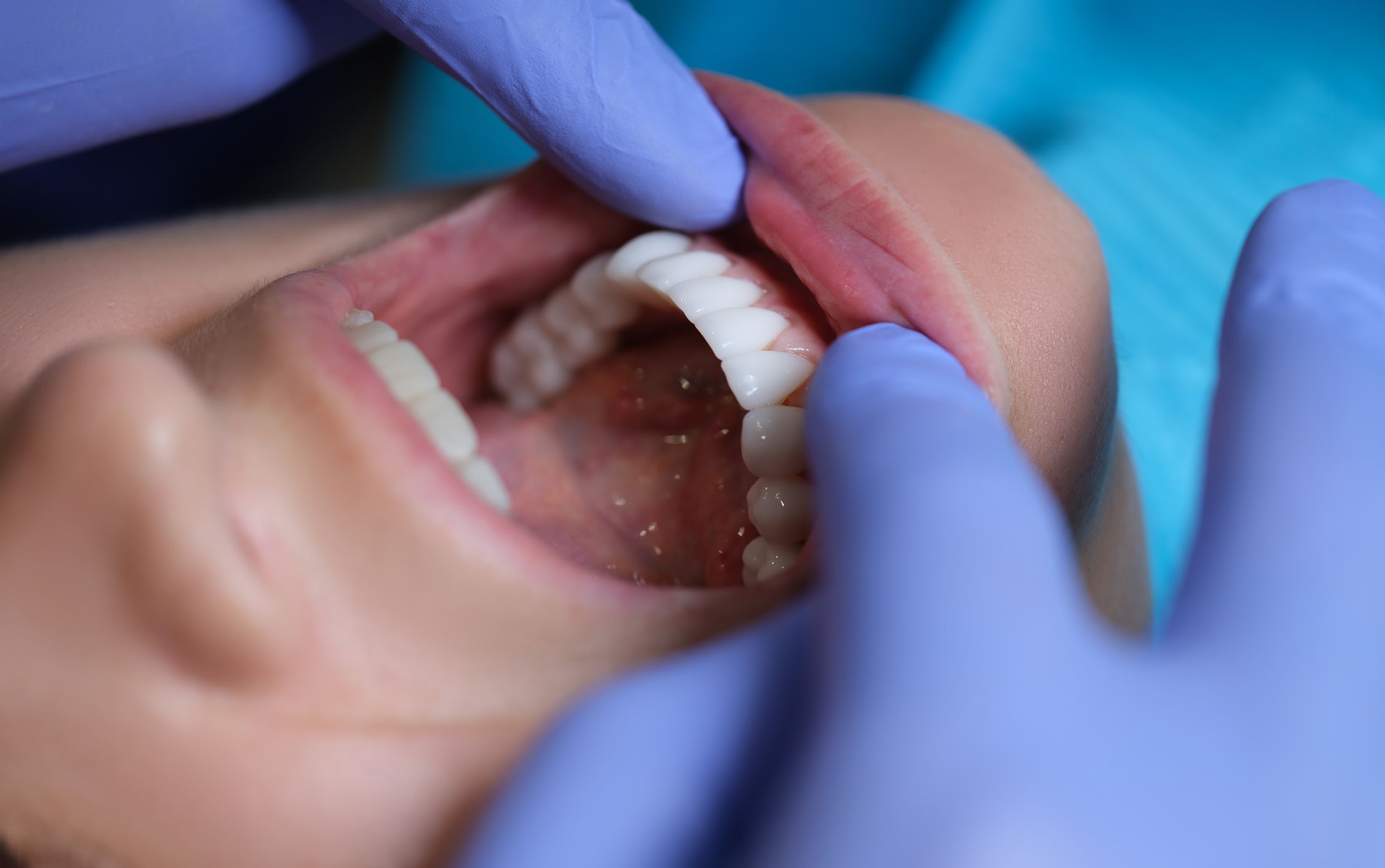 oral cancer screening