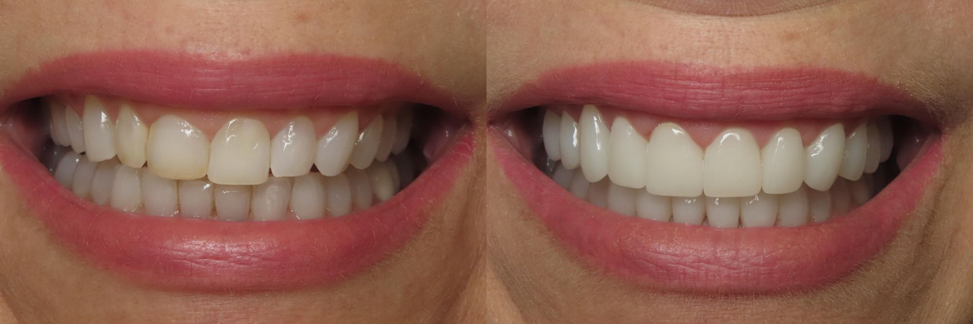 porcelain veneers before and after