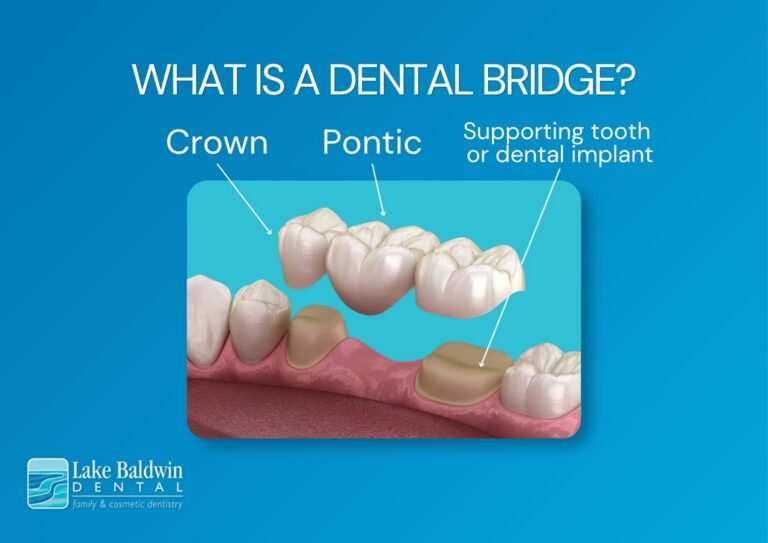 Image shows a dental bridge and how it sits on prepared teeth. Our team crafts custom dental bridges in Orlando, serving Baldwin Park and Avalon Park.